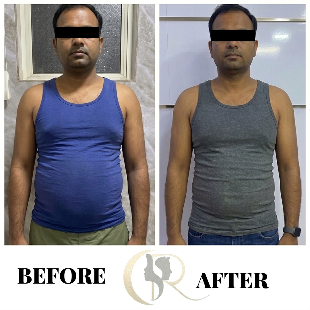 Advanced Bariatric & Weight Loss Surgery in Hyderabad