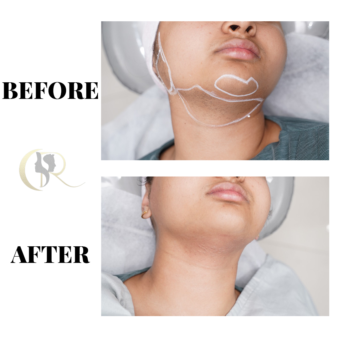Treatment result