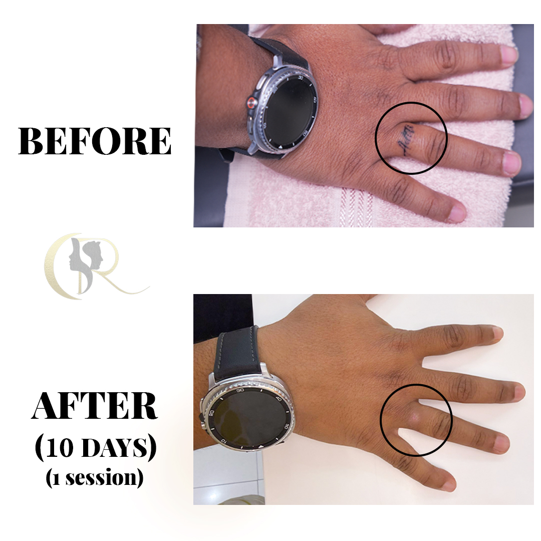 Best Tattoo Removal in Hyderabad | 1-Session Surgery & Pico Laser
