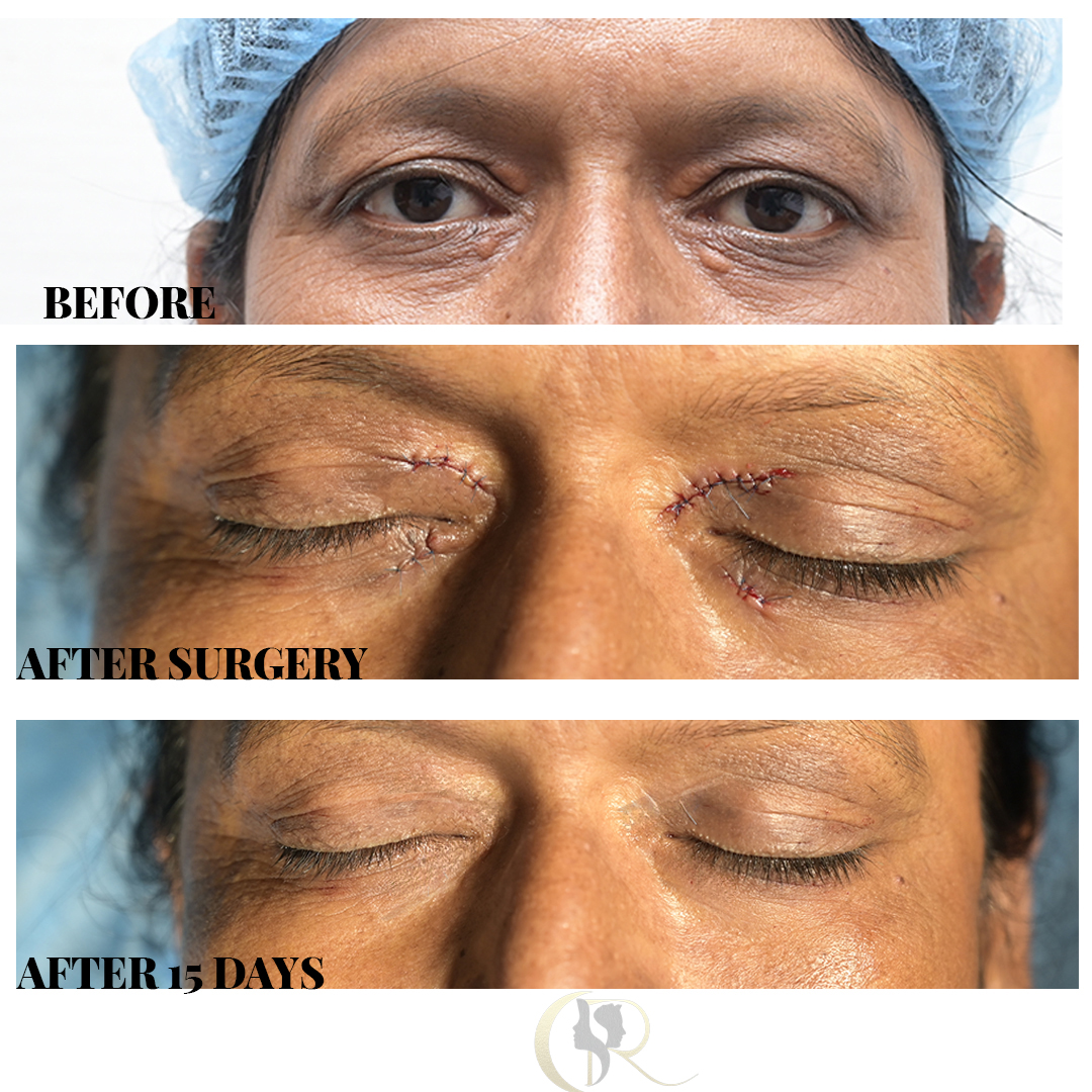 Best Blepharoplasty Surgery in Hyderabad | Eyelid & Ptosis Treatment