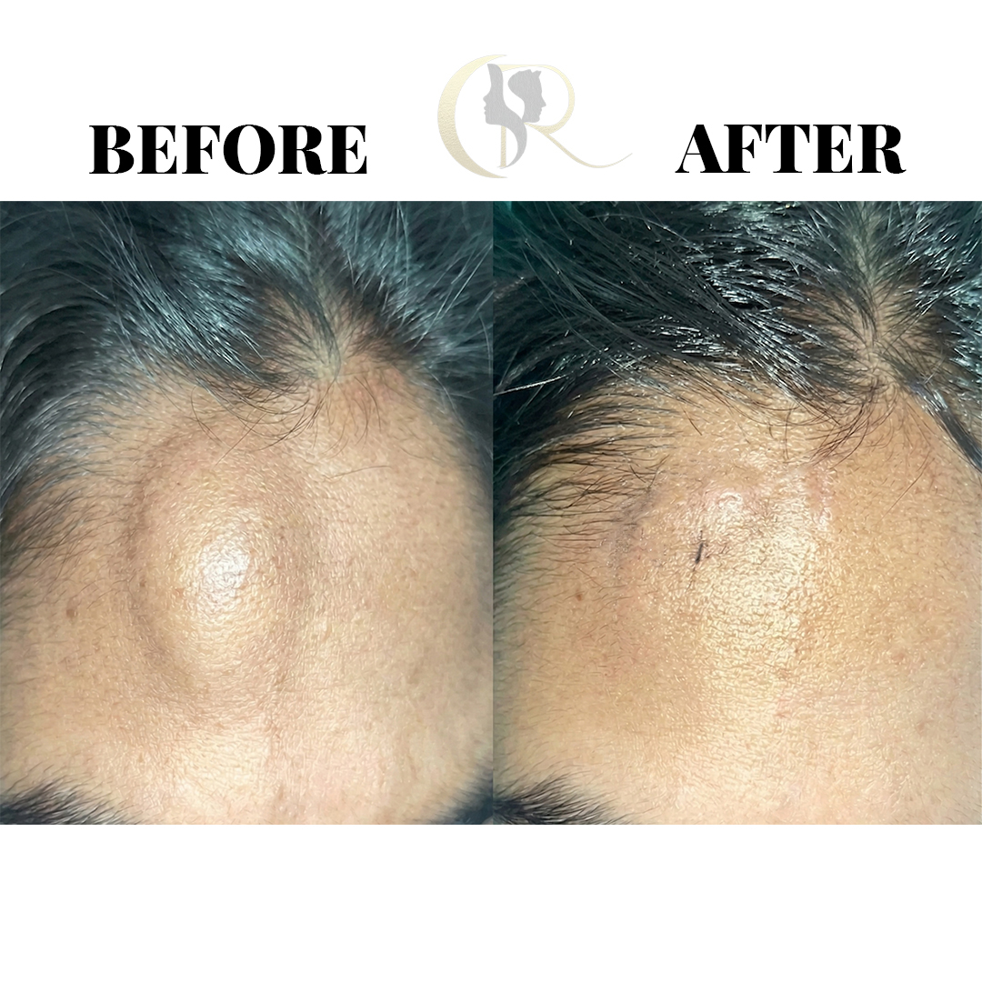 15-Min Sebaceous Cyst & Lipoma Removal in Hyderabad