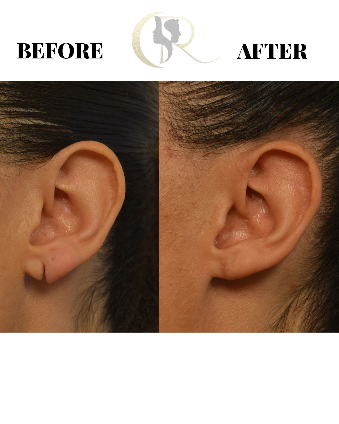 15-Min Ear Hole Repair & Earlobe Repair in Hyderabad