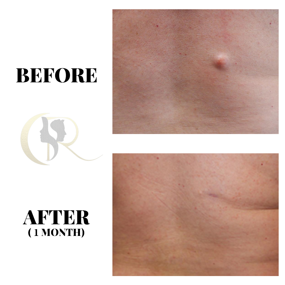 15-Min Sebaceous Cyst & Lipoma Removal in Hyderabad