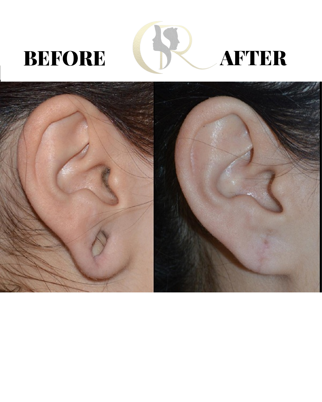 15-Min Ear Hole Repair & Earlobe Repair in Hyderabad