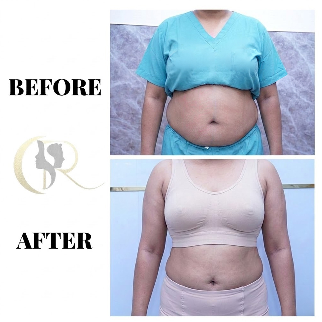 Best Tummy Tuck Surgeon in Hyderabad | Abdominoplasty
