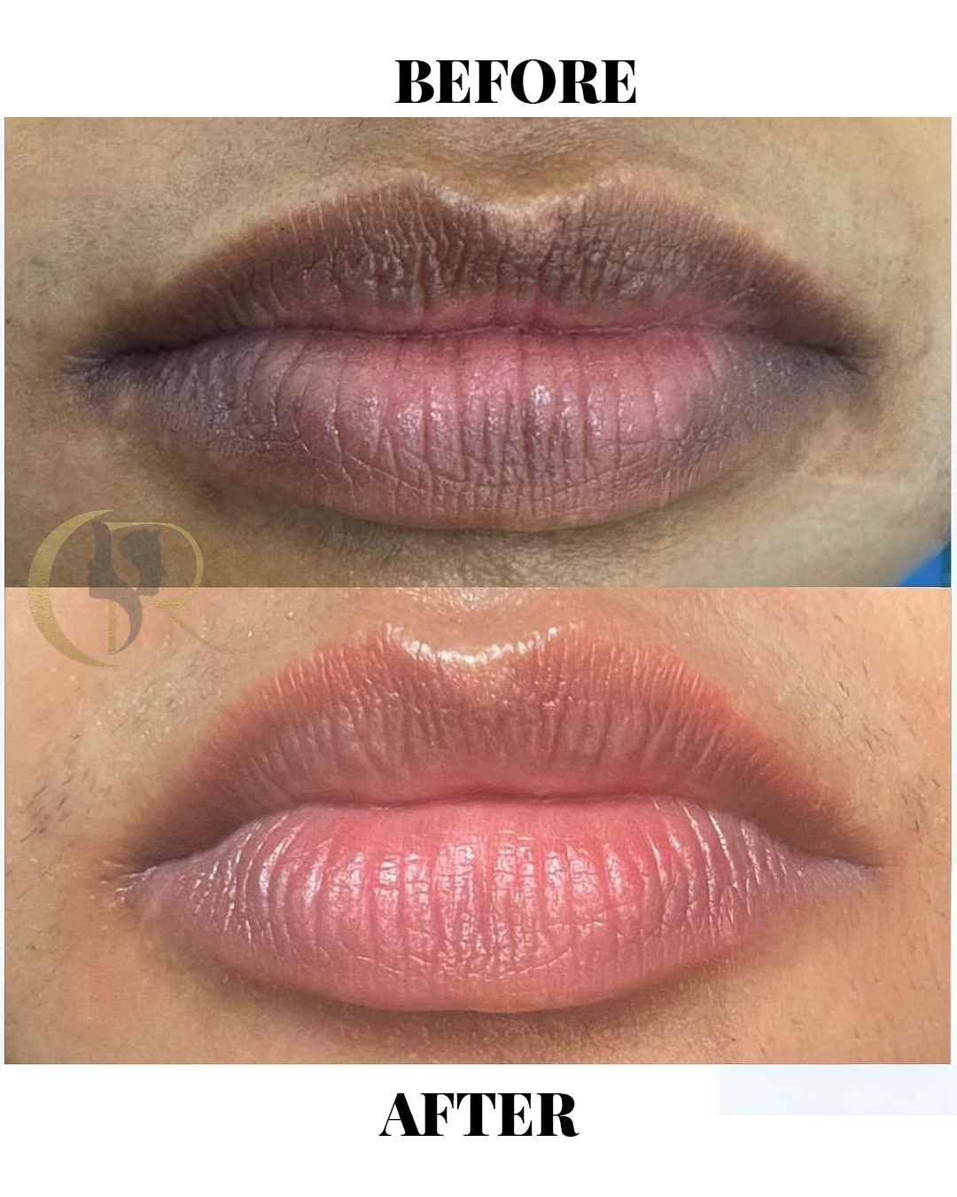 Dark Lips Treatment & Laser Lip Lightening in Hyderabad
