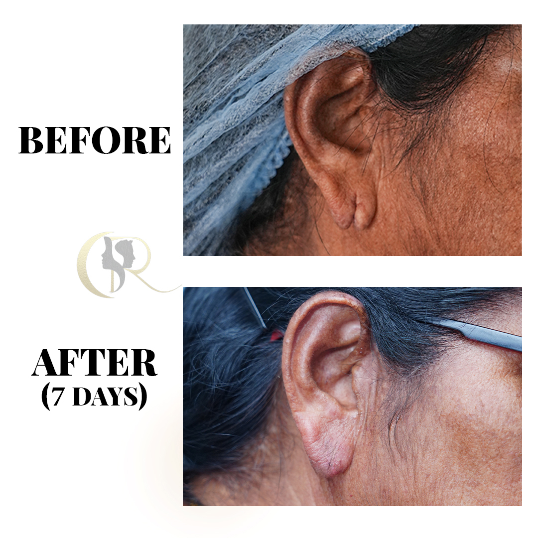 15-Min Ear Hole Repair & Earlobe Repair in Hyderabad