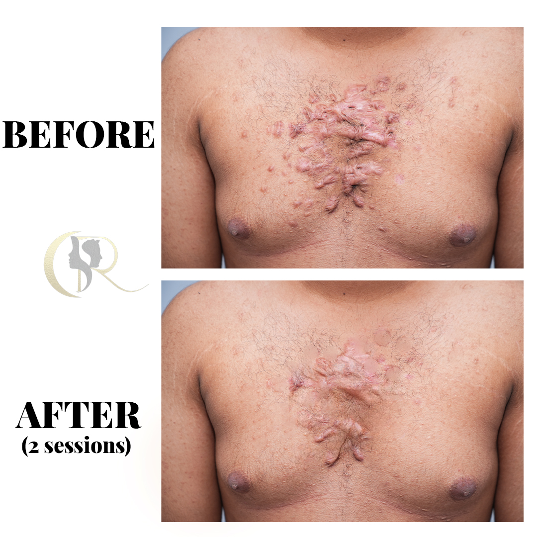 Permanent Keloid Removal & Hypertrophic Scar Treatment in Hyderabad