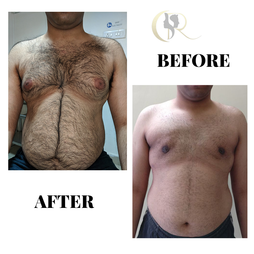Best Gynecomastia Surgery in Hyderabad | Men Chest Fat Removal