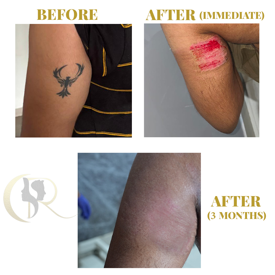 Best Tattoo Removal in Hyderabad | 1-Session Surgery & Pico Laser