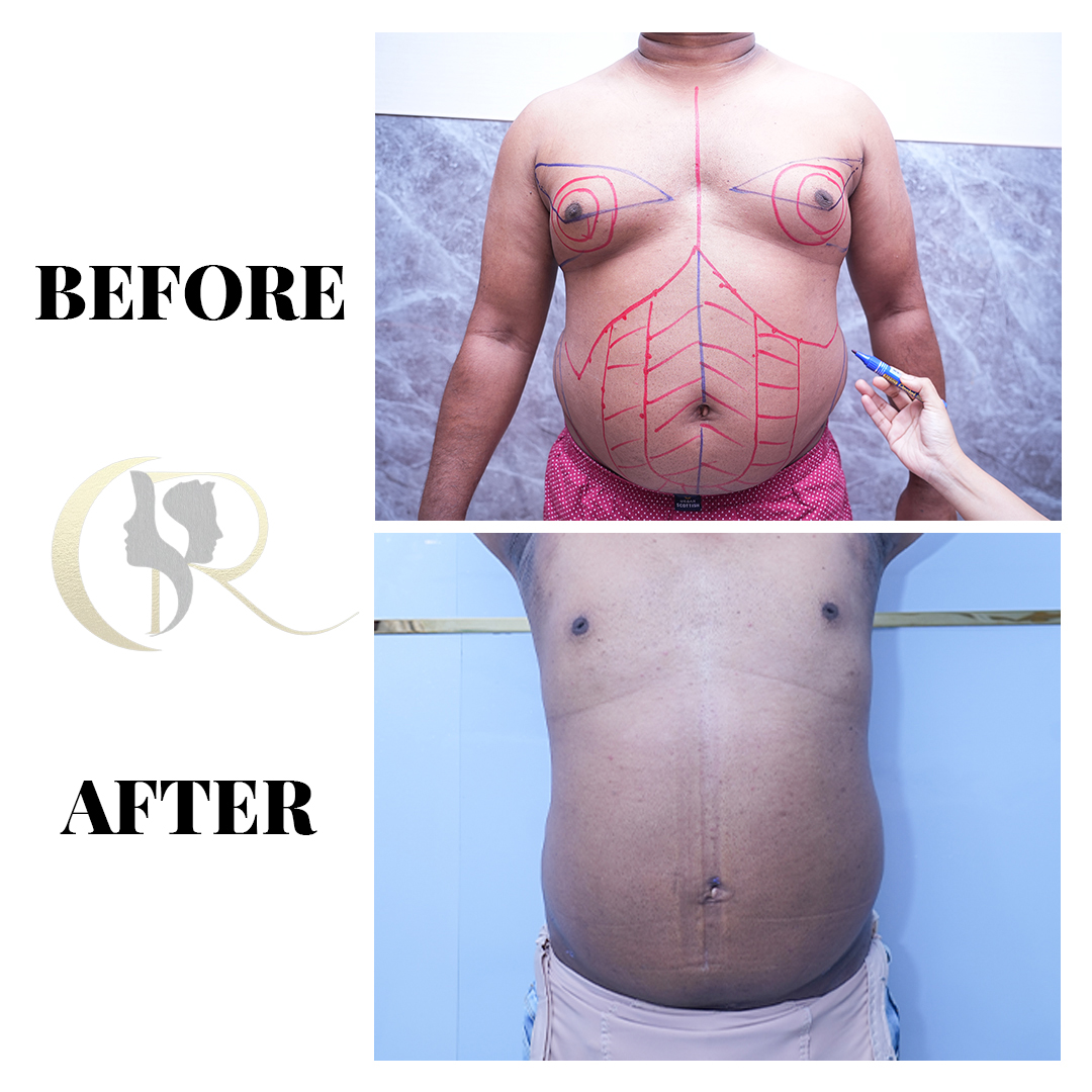 Best Tummy Tuck Surgeon in Hyderabad | Abdominoplasty