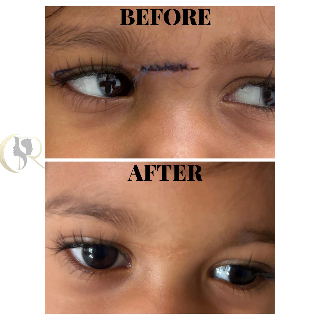 CO2 Fractional Laser & Scar Revision Surgery in Hyderabad