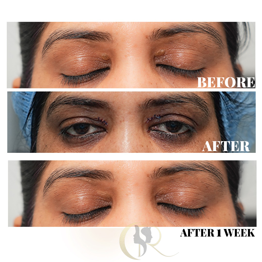 Best Blepharoplasty Surgery in Hyderabad | Eyelid & Ptosis Treatment