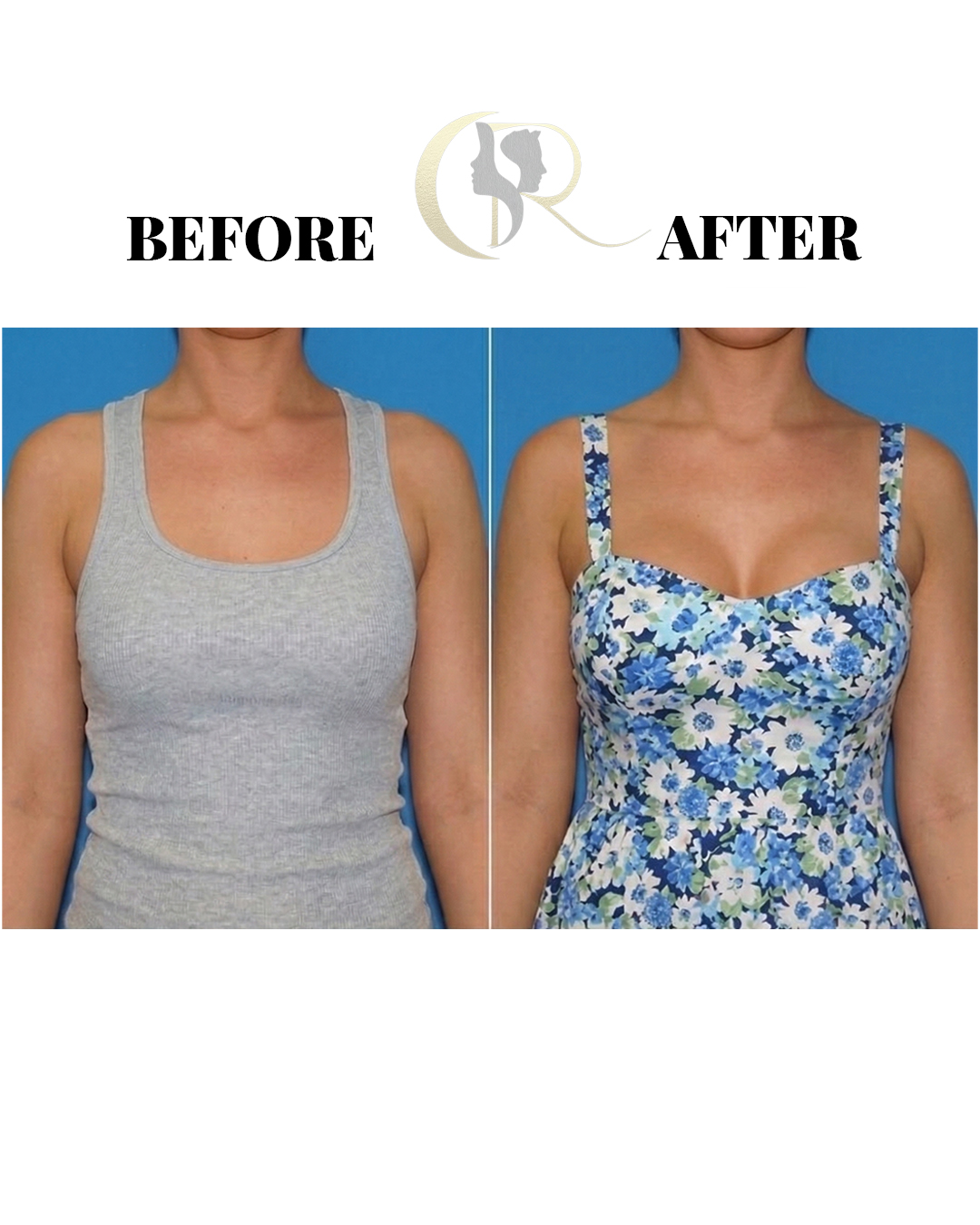 Advanced Breast Augmentation (Implants) in Hyderabad