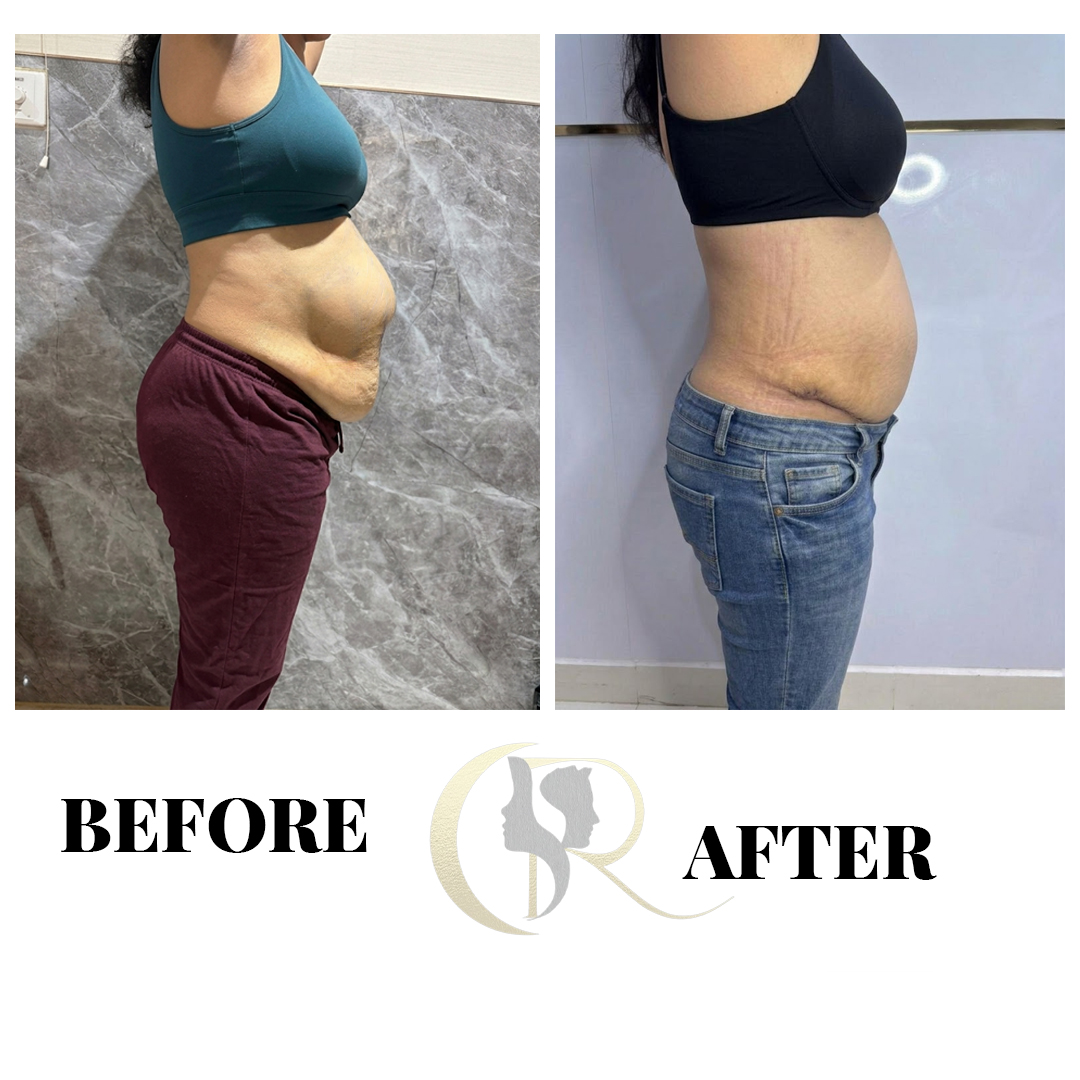 VASER Liposuction in Hyderabad | High-Definition 360 Liposculpture