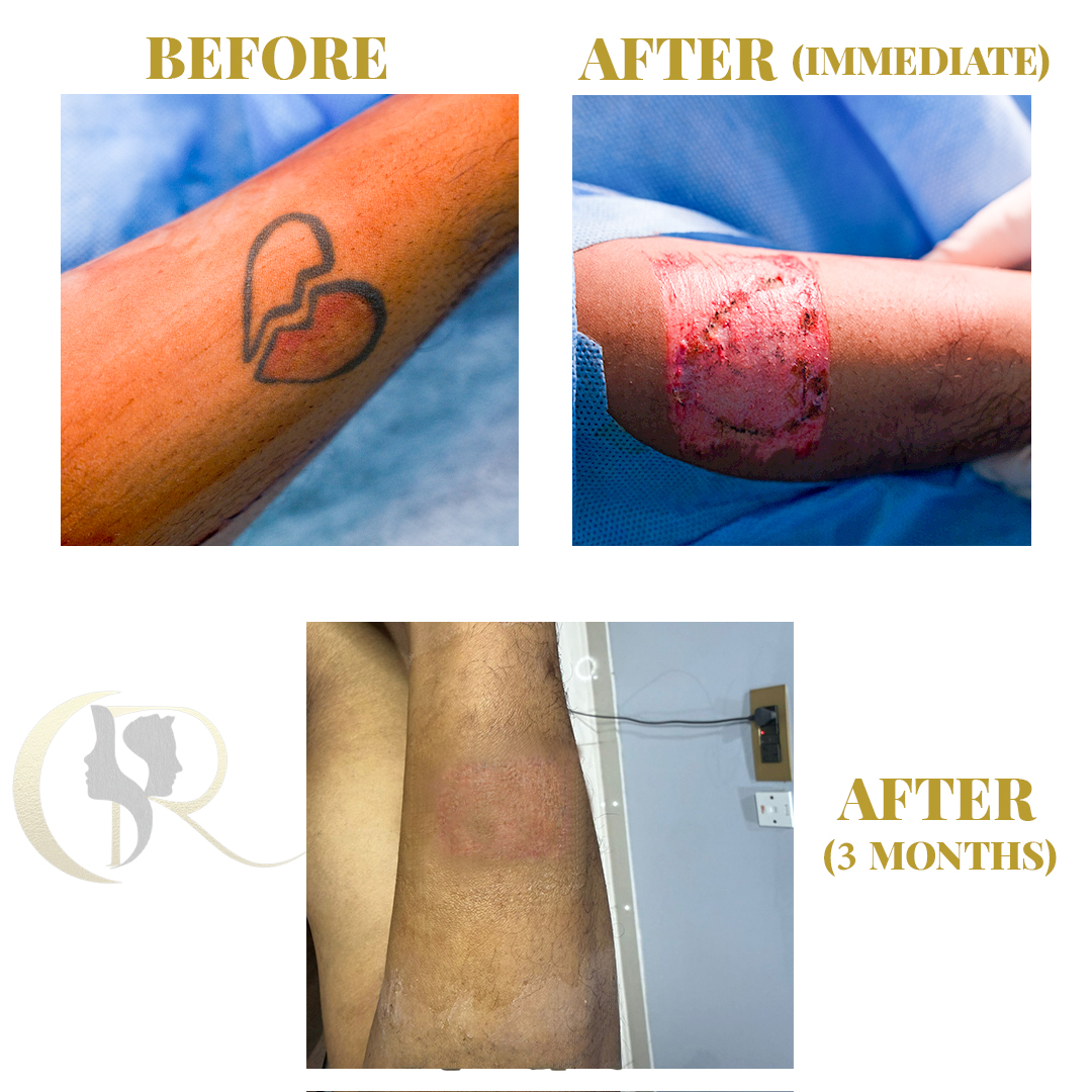 Best Tattoo Removal in Hyderabad | 1-Session Surgery & Pico Laser