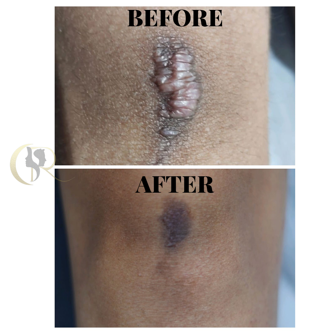 Permanent Keloid Removal & Hypertrophic Scar Treatment in Hyderabad