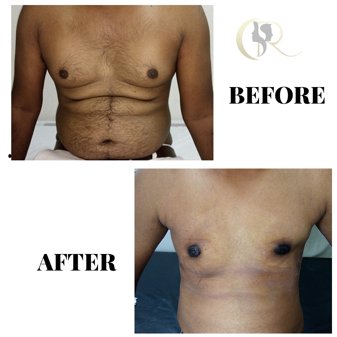 Best Gynecomastia Surgery in Hyderabad | Men Chest Fat Removal