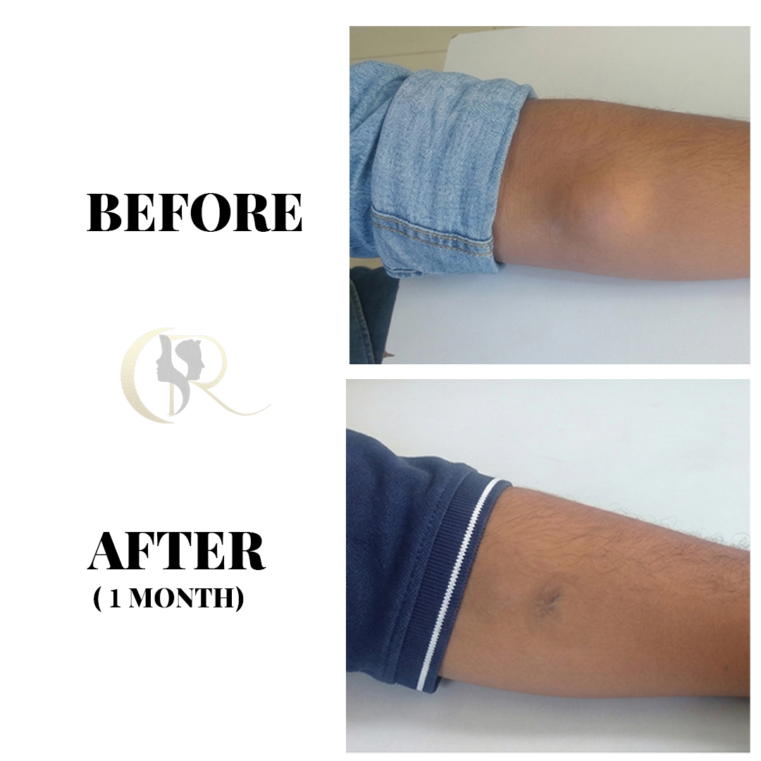 15-Min Sebaceous Cyst & Lipoma Removal in Hyderabad